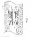 Fig. 13 - Bronchial flow control devices and methods of use