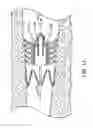 Fig. 14 - Bronchial flow control devices and methods of use