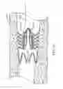 Fig. 15 - Bronchial flow control devices and methods of use