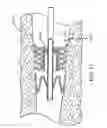 Fig. 17 - Bronchial flow control devices and methods of use