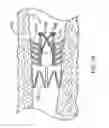 Fig. 23 - Bronchial flow control devices and methods of use