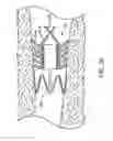 Fig. 24 - Bronchial flow control devices and methods of use