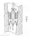 Fig. 25 - Bronchial flow control devices and methods of use