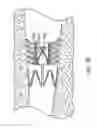 Fig. 26 - Bronchial flow control devices and methods of use