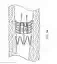 Fig. 28 - Bronchial flow control devices and methods of use