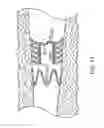 Fig. 29 - Bronchial flow control devices and methods of use