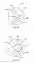 Fig. 45 - Bronchial flow control devices and methods of use