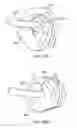 Fig. 46 - Bronchial flow control devices and methods of use