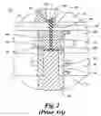 Fig. 03 - Method for making plastic overcaps using hot runner back-gated mold technology