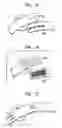 Fig. 06 - Adjustable plastic carry strap having laterally projecting foldable handles