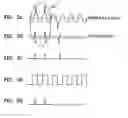 Fig. 04 - Land Pre-Pit data detection apparatus and method thereof