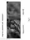 Fig. 14 - Medical implants and fibrosis-inducing agents