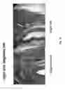Fig. 15 - Medical implants and fibrosis-inducing agents