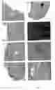 Fig. 09 - Method of diagnosis of inflammatory diseases using calgranulin c
