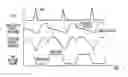 Fig. 01 - Timing of intra-aortic balloon pump therapy