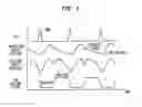 Fig. 03 - Timing of intra-aortic balloon pump therapy