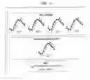 Fig. 11 - Timing of intra-aortic balloon pump therapy