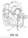 Fig. 05 - Transventricular implant tools and devices