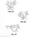 Fig. 15 - Transventricular implant tools and devices