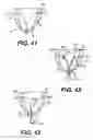 Fig. 16 - Transventricular implant tools and devices