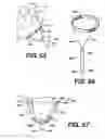Fig. 22 - Transventricular implant tools and devices