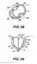 Fig. 23 - Transventricular implant tools and devices
