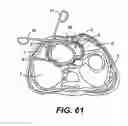 Fig. 25 - Transventricular implant tools and devices