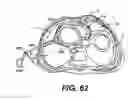 Fig. 26 - Transventricular implant tools and devices