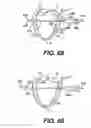 Fig. 29 - Transventricular implant tools and devices