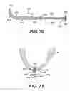 Fig. 30 - Transventricular implant tools and devices