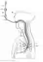 Fig. 01 - Method and apparatus for performing transgastric procedures
