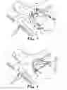 Fig. 04 - Transabdominal surgery system
