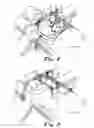 Fig. 07 - Transabdominal surgery system
