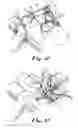 Fig. 09 - Transabdominal surgery system