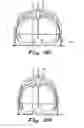 Fig. 14 - Transabdominal surgery system