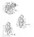 Fig. 02 - Device to permit offpump beating heart coronary bypass surgery