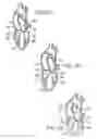 Fig. 03 - Device to permit offpump beating heart coronary bypass surgery