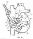 Fig. 10 - Device to permit offpump beating heart coronary bypass surgery