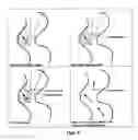 Fig. 33 - Stereo display of tube-like structures and improved techniques therefor (
