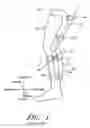 Fig. 02 - Orthopedic brace suspension system