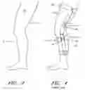 Fig. 04 - Orthopedic brace suspension system