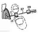 Fig. 01 - Device for targeted, catherized delivery of medications