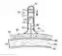 Fig. 01 - Apparatus and method for accessing the bone marrow