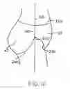 Fig. 08 - Disposable absorbent garment with elastic inner layer having multiple fasteners