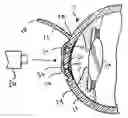 Fig. 01 - Device and method for reshaping the cornea