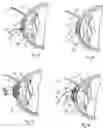 Fig. 05 - Device and method for reshaping the cornea