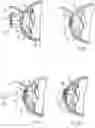 Fig. 06 - Device and method for reshaping the cornea