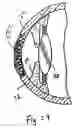 Fig. 09 - Device and method for reshaping the cornea