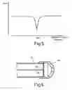 Fig. 04 - Tissue resurfacing