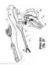 Fig. 03 - Movable handle for vessel sealer